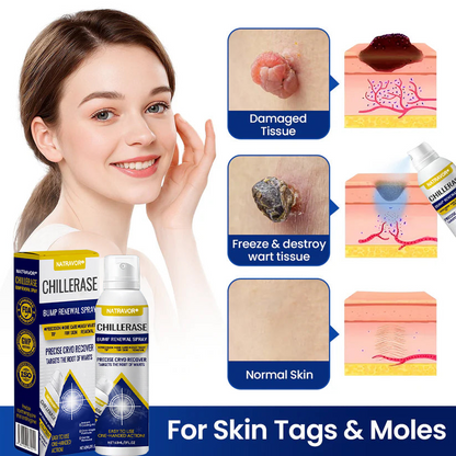 Natravor® ChillErase Bump Renewal Spray🇺🇸👨‍⚕️⚕️ FDA Certified （Zero Pain, Smooth Skin | Flatten Bumps Fast | Calm Redness & Irritation | ）🔥🎁