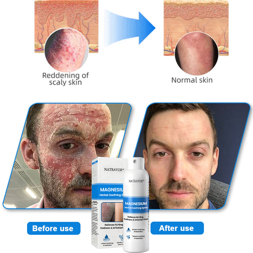 🔥 Natravor® Magnesium Spray – Fast Relief for Itchy, Red & Sensitive Skin (Even Intimate Areas)